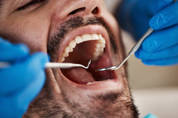 Best Emergency Root Canal Treatment in French Island, WI